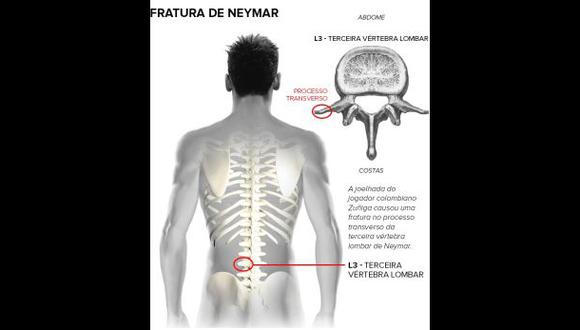 Neymar fuera del Mundial: esta es la lesión del brasileño