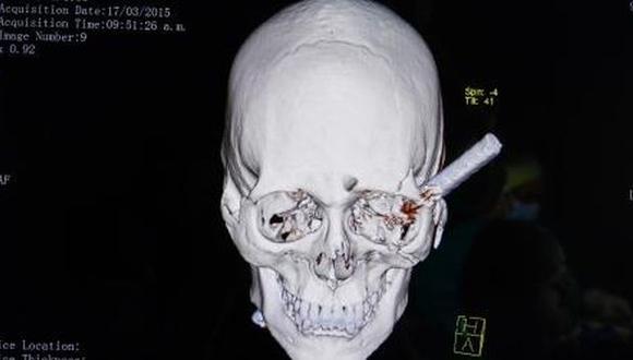 Obrero sobrevive a operación para sacarle varilla de la cabeza