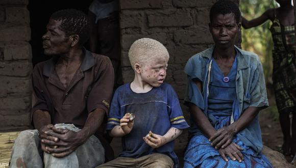 Sudáfrica: Curandero mató a una persona albina por un rito
