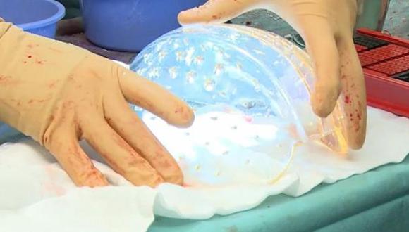 Realizan primer trasplante de cráneo impreso en 3D en una niña