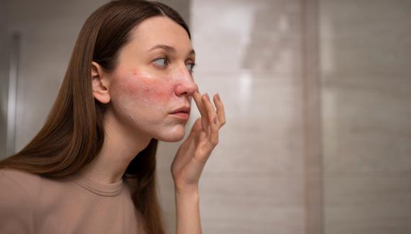 La combinación de calor y exposición solar puede llevar a un aumento en el enrojecimiento facial, uno de los síntomas principales de la rosácea.