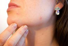 3 tips para evitar el acné en el cuello 