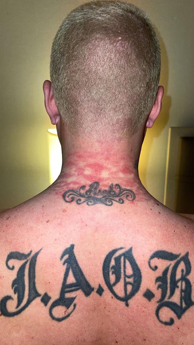 This is how J Balvin's neck remained after the Met Gala 2021. (Photo: @jbalvin). 
