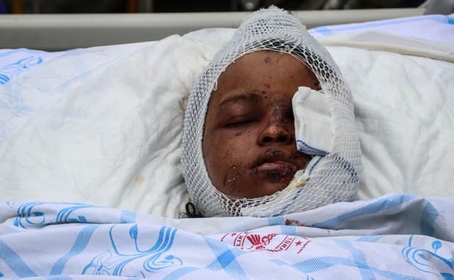 Una niña que fue herida en el atentado que el sábado dejó 79 muertos en Mogadiscio, la capital de Somalia. (AFP / Abdirazak Hussein FARAH).