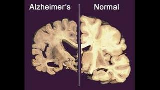 Hallazgo que ganó el Nobel da esperanza contra el Alzheimer