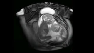 Gemelos son captados peleando por espacio en el vientre de su madre gracias a moderna resonancia magnética