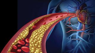 ¿Qué es la Enfermedad Obstructiva de las Arterias Coronarias y cómo prevenirla?