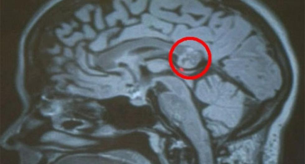 Un examen determinó que la joven no tenía un tumor en la cabeza. (Foto: Agencias)