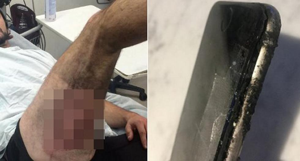 Australiano resultó herido tras explosión de su iPhone. (Foto: 7 News Sydney)