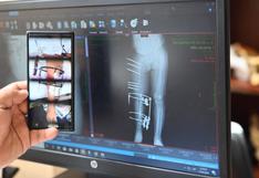 Proeza médica: cirujanos del INSN salvan pierna de niño que sufrió grave accidente cuando tenía un año