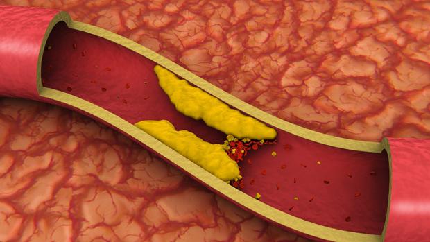 Bad cholesterol can cause a narrowing of the blood vessels.