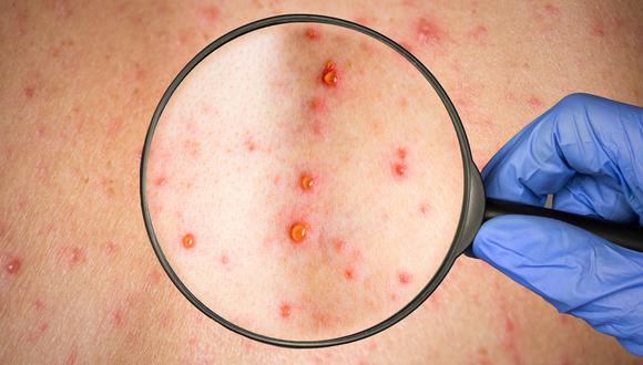 A pesar de tener síntomas similares, el sarampión y la varicela son infecciones completamente distintas con orígenes y tratamientos diferentes.