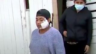 Villla El Salvador: joven es desfigurado por dos pitbulls y no tiene dinero para tratamiento