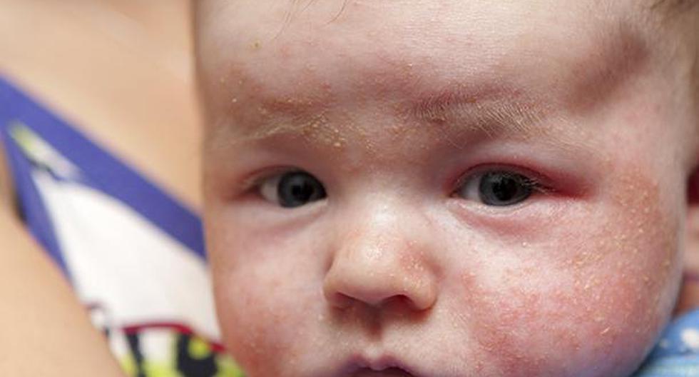 La dermatitis atópica suele afectar a los bebés. (Foto: IStock)