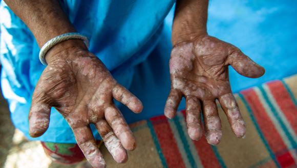 Qué se sabe sobre los 12 casos de lepra en México