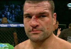 UFC Fight Night: Así quedó el rostro de Shogun tras el nocaut de Henderson