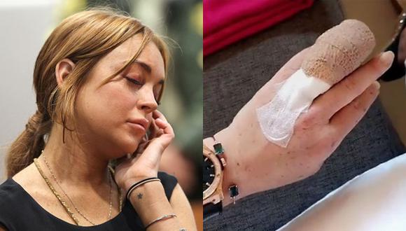 Lindsay Lohan perdió parte del dedo de la mano en accidente