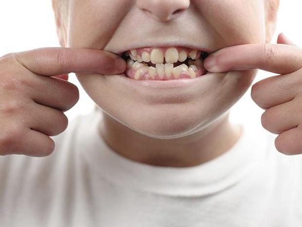 Los espacios apretados entre los dientes pueden dificultar el acceso del cepillo de dientes y el hilo dental, lo que facilita la acumulación de restos de comida y bacterias. Esto aumenta el riesgo de desarrollar caries.