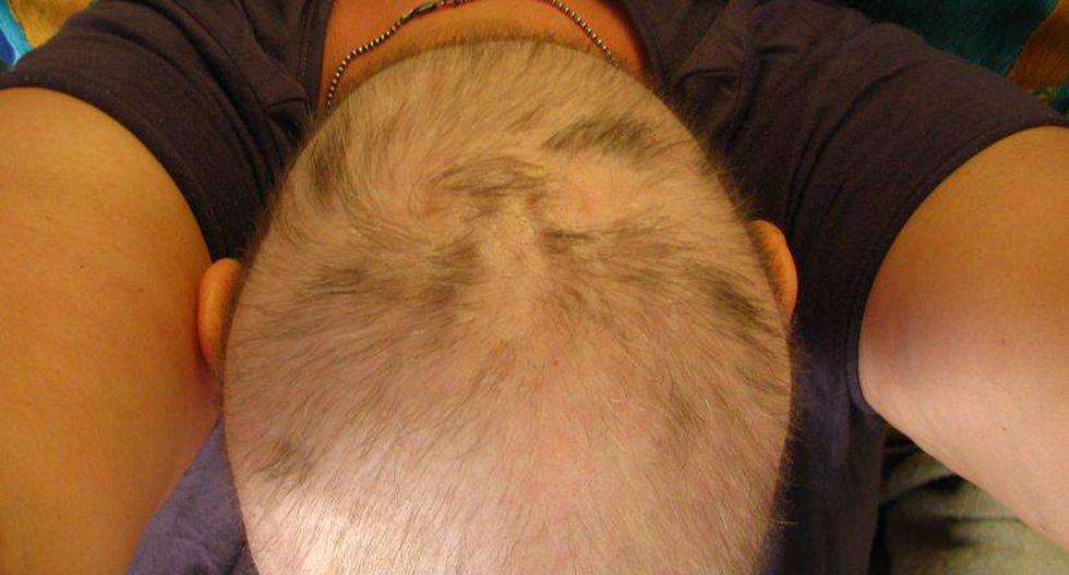La alopecia puede afectar a las personas más jóvenes debido a varios factores. (Foto: wiccked/Flickr)