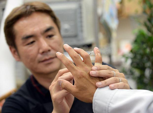 Muchos exmiembros de la yakuza que se practicaron el yubitsume se reconstruyen el meñique con prótesis para reinsertarse en la sociedad japonesa, donde un dedo cortado implica un fuerte estigma. (GETTY IMAGES).
