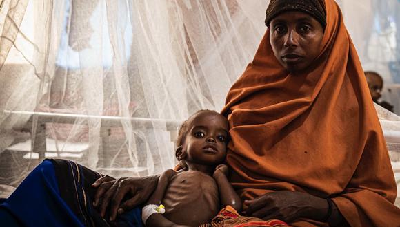 Muchos niños tienen graves problemas de salud debido a la falta de alimentos en Somalia. (GETTY IMAGES).