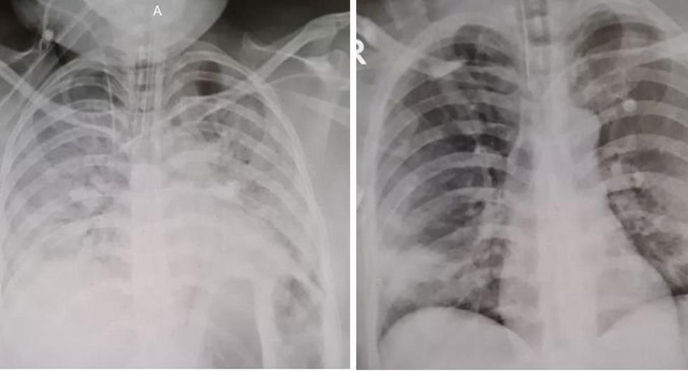 En estas placas radiográficas, se observan los pulmones de un paciente con COVID-19 no vacunado y los de un paciente vacunado. ¿Notas la diferencia? En esta nota te lo explicamos.
