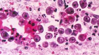 Ameba “come cerebros”: Florida emite una alerta de salud tras un raro caso de infección por el parásito 