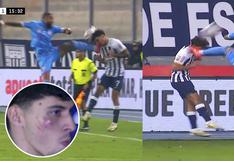 Así quedó la cara de Franco Zanelatto tras patada de Alexi Gómez | VIDEO