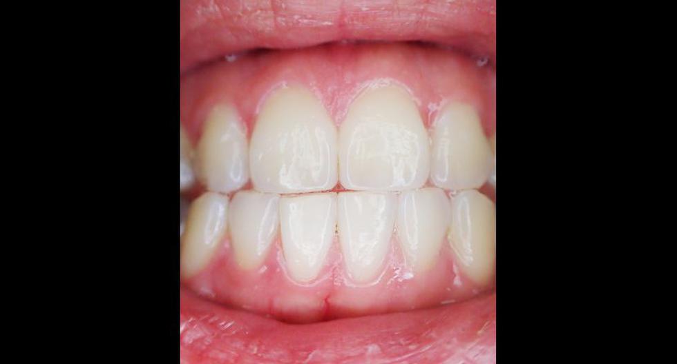 Imagen referencial de dientes. (Foto: Pixabay)