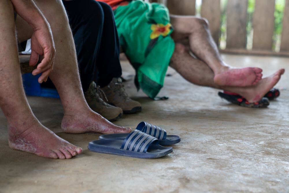 One of the most common conditions that migrants present when they arrive in Bajo Chiquito, the first town after crossing the Darién, is the damage to their feet after days walking in a tropical jungle.  The feet are constantly wet, in contact with sand and mud, and end up swollen and damaged to such an extent that some cannot continue walking and give up in Darien itself.  (MSF/Sara de la Rubia).