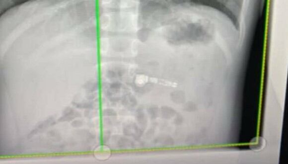 Al realizarse unos exámenes, los médicos detectaron un AirPod en la caja torácica del niño. (Foto: Facebook / Kiara Stroud)