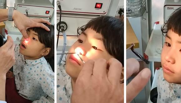 Doctor extrae con éxito una sanguijuela de más de siete centímetros alojada en la nariz de una niña. (Foto: ViralHog en YouTube)