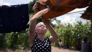Supersticiones que pueden costarle la vida a los albinos en África