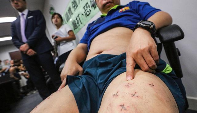 Hong Kong pro-democracy activist Howard Lam, who claims he was abducted, blindfolded and beaten by mainland China agents, shows his stapled thighs and injuries during a press conference in Hong Kong on August 11, 2017. Lam, a member of a Hong Kong pro-democracy party, claimed on August 11 he was abducted and beaten by mainland agents after promising to send a signed photo of footballer Lionel Messi to the wife of late Chinese dissident Liu Xiaobo. -  - Hong Kong OUT - China OUT - Taiwan OUT / -----EDITORS NOTE --- RESTRICTED TO EDITORIAL USE - MANDATORY CREDIT "AFP PHOTO / SCMP / FELIX WONG" - NO MARKETING - NO ADVERTISING CAMPAIGNS - DISTRIBUTED AS A SERVICE TO CLIENTS - NO ARCHIVES - NO INTERNET
 / AFP / SOUTH CHINA MORNING POST / FELIX WONG / -----EDITORS NOTE --- RESTRICTED TO EDITORIAL USE - MANDATORY CREDIT "AFP PHOTO / SCMP / FELIX WONG" - NO MARKETING - NO ADVERTISING CAMPAIGNS - DISTRIBUTED AS A SERVICE TO CLIENTS - NO ARCHIVES - NO INTERNET