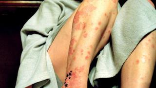 Terapia logra blanquear la piel de pacientes con psoriasis