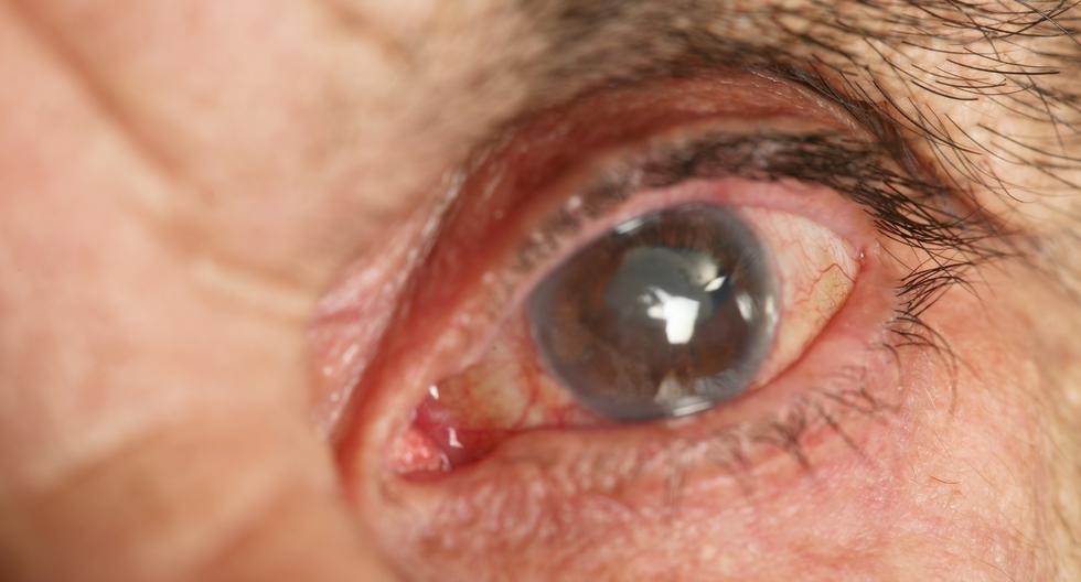 El glaucoma es un grupo de afecciones del ojo que dañan el nervio óptico, según Mayo Clinic.