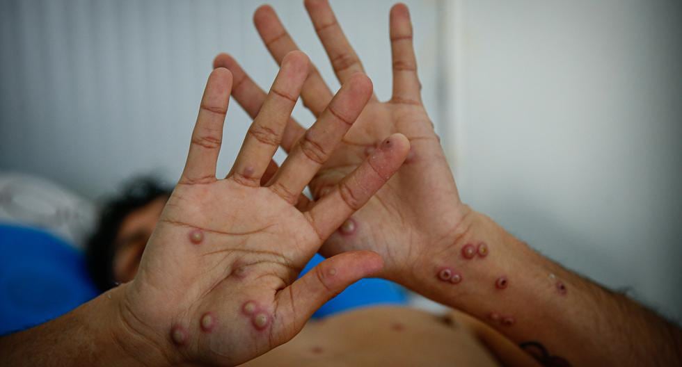 Distritos de Lima lideran el índice de contagios de esta enfermedad. A la fecha más de la mitad de pacientes ha sido dado de alta (Foto: Hugo Curotto)