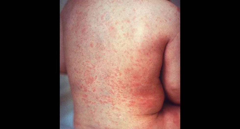 Espalda de paciente enfermo de sarampión. (Foto: Wikimedia)