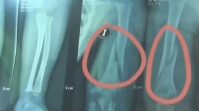 La fractura que presenta en el brazo el menor de 4 años luego de haber sido maltratado físicamente. (Captura: Tv Perú)
