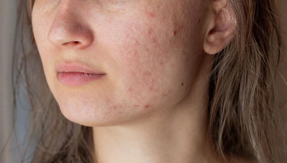 Conoce los tipos de acné que existen y por qué se producen en esta nota. (Foto: iStock)