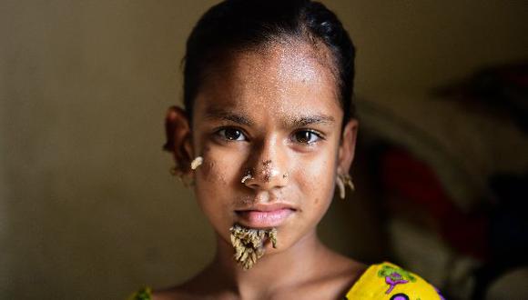 Operan con éxito a la 'niña árbol' de Bangladesh