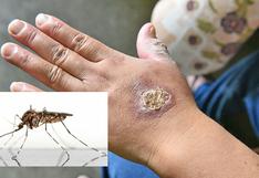 Alerta por aumento de casos de uta transmitida por mosquitos en Lima y regiones