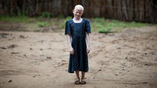 Por qué a los albinos de Tanzania los "matan como a animales"