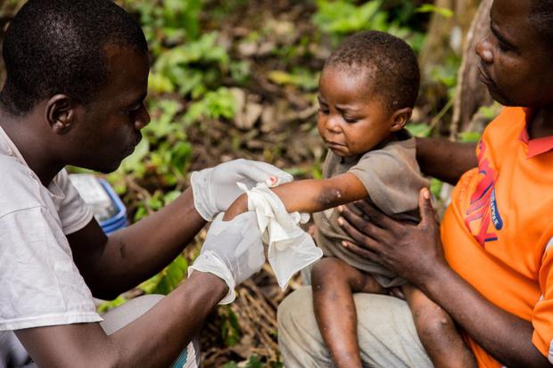 Un niño afectado por la viruela del mono se sienta en las piernas de su padre mientras recibe tratamiento en el centro de la ONG Médicos sin Fronteras en Zomea Kaka, República Centroafricana el 18 de octubre del 2018. (CHARLES BOUESSEL / AFP).