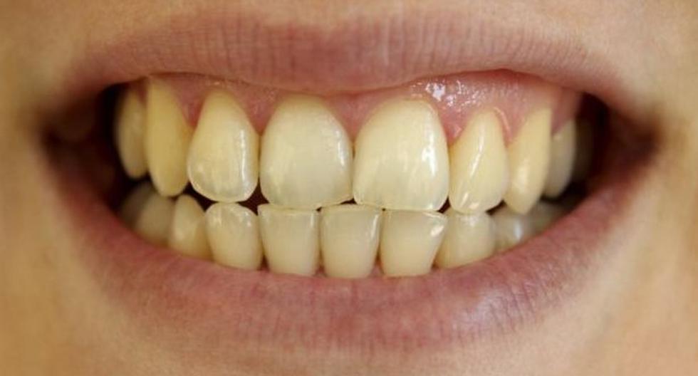 Todos quieren tener dientes blancos. (Foto: Difusión)