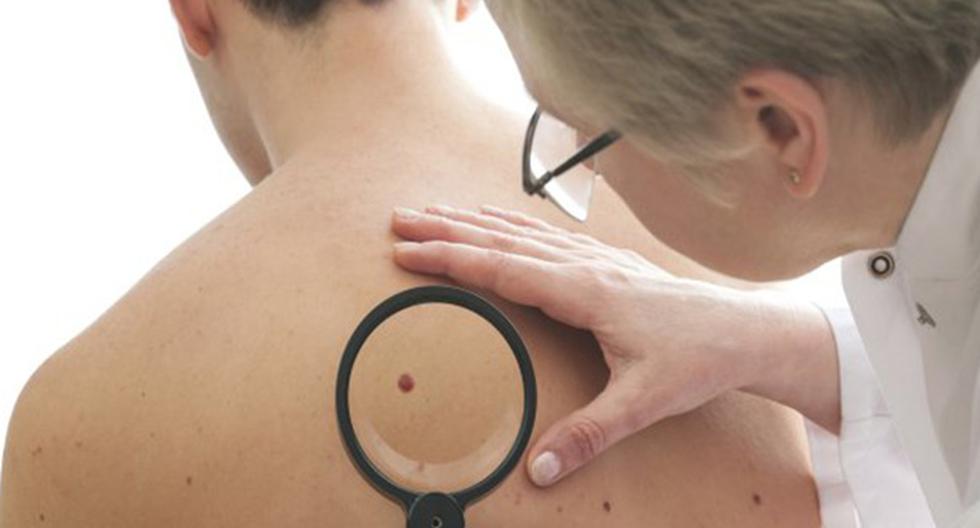 Recomendaciones para protegerte del cáncer de piel. (Foto: ThinkStock)