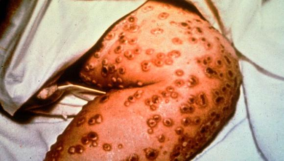 Esta foto de archivo sin fecha obtenida de los Centros para el Control y la Prevención de Enfermedades muestra las lesiones de la viruela en la pierna de una persona. (FOTO: AFP/HO).