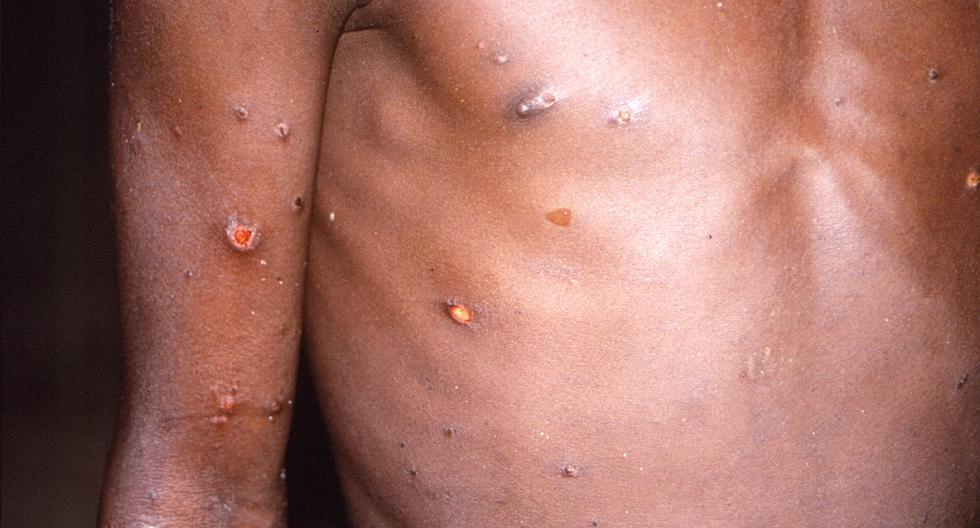 US authorities confirm 12 cases of monkeypox so far