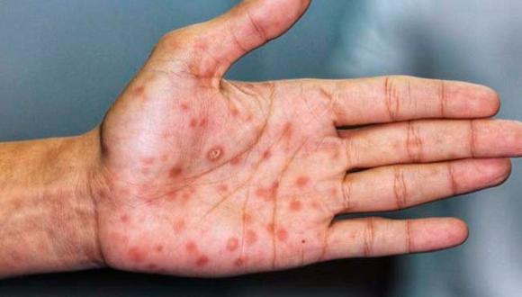 Los casos descartados hasta ahora en Lima se trataban de otras enfermedades eruptivas como la varicela, y enfermedad de mano, pie y boca. (Foto referencial GEC)