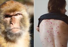 Viruela del mono: ¿qué hago si tengo los síntomas?